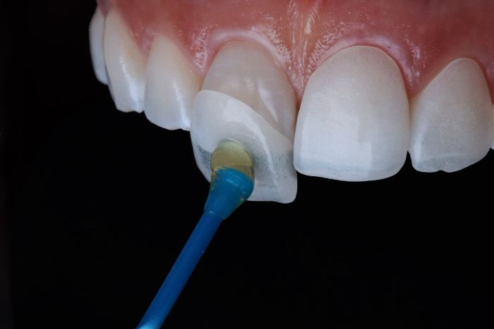 Dental veeners in Islamabad