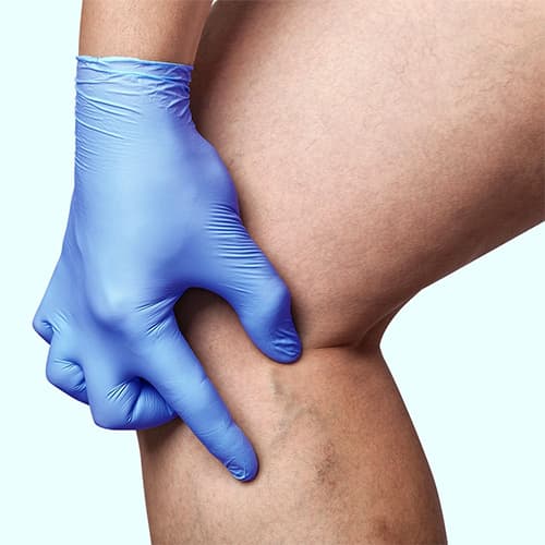 Does spider vein removal really work?