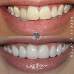 Crest White Strips