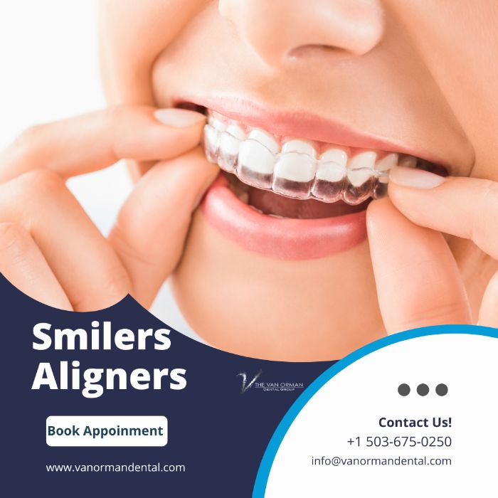 How Do Smilers Aligners Work? How Do Smilers Aligners Work?