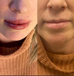 Botox Filler Injections Etobicoke