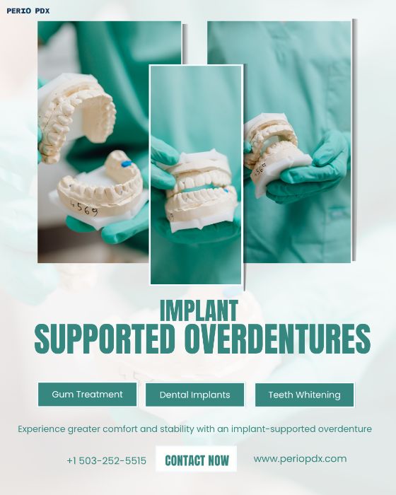 How Long Do ImplantSupported Overdentures Last?