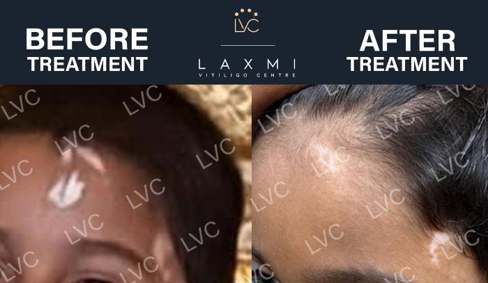 Effective Vitiligo Leucoderma Cure