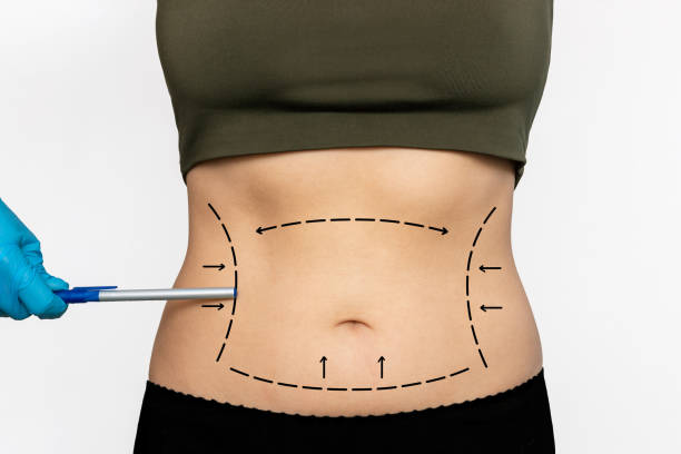 Liposuction in Riyadh Liposuction in Riyadh