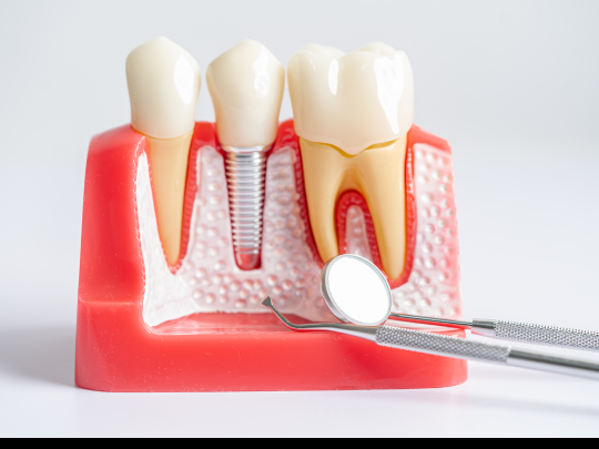 Root Canal Therapy: StepbyStep Procedure Explained
