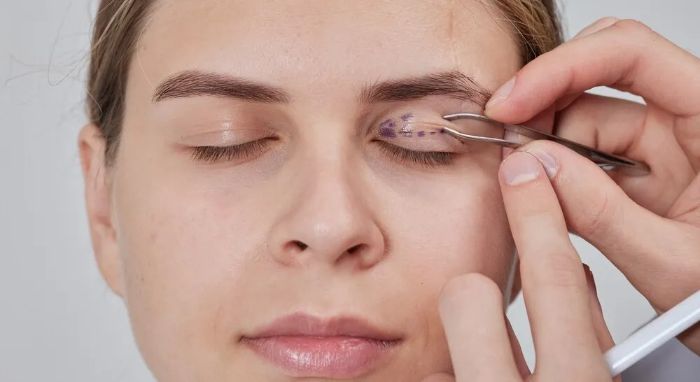 Eyelid Surgery in Islamabad