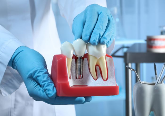 What Are Denture Implants? What Are Denture Implants?