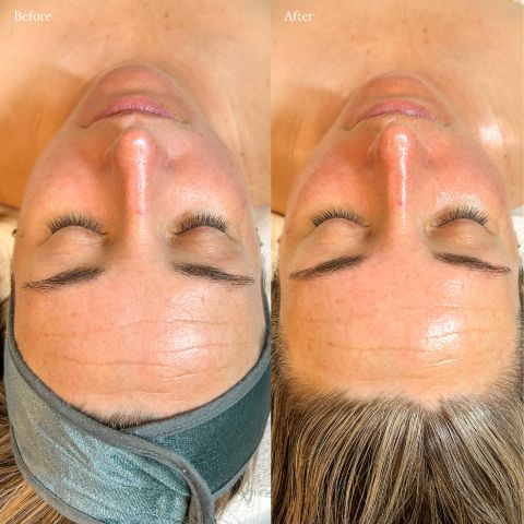 Lux LED Facial Therapy