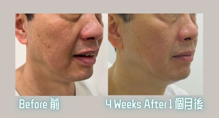 Best Sofwave Treatment in Richmond Hill