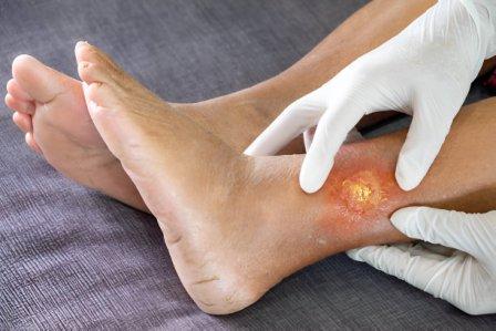 Infection Control Debridement Service