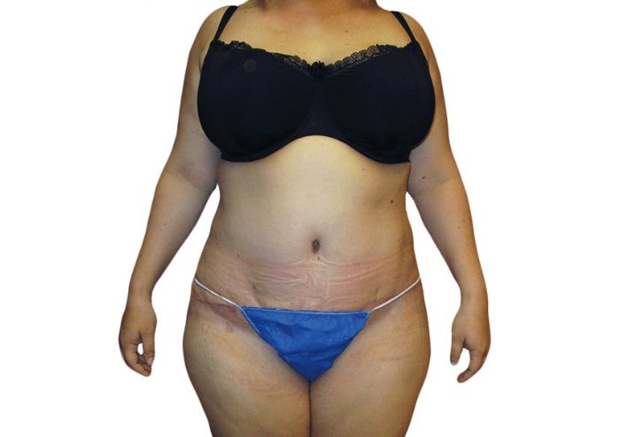 How does abdominoplasty differ from liposuction?