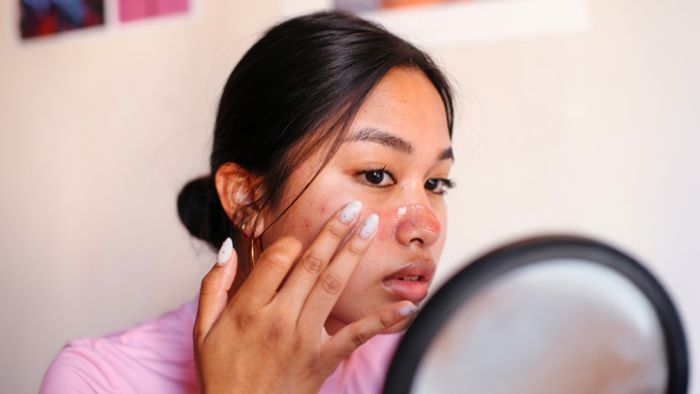 Improve Skin Texture After Breakouts