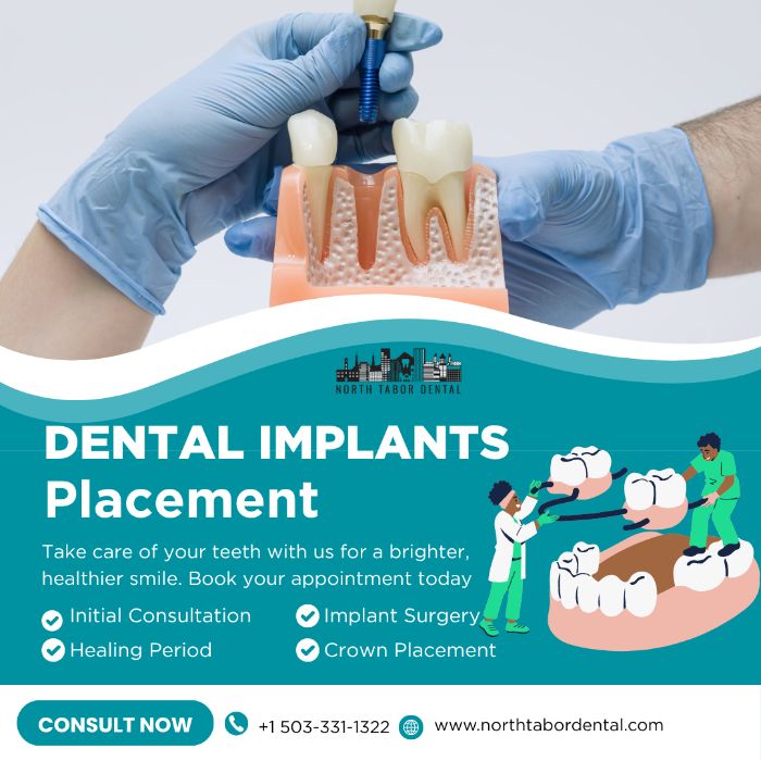 How Safe Is Dental Implants Placement?