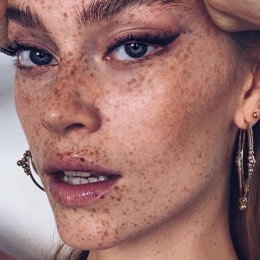 Advanced Skin Pigmentation Treatment Toronto