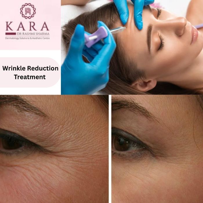 Refresh Your Look with Advanced Anti Wrinkle Treatments
