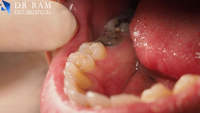 Laser tonsillectomy