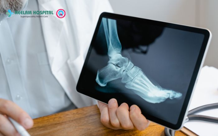 fracture healing natural remedies
