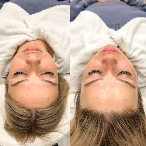 Acne Treatment MD Treatment Lounge
