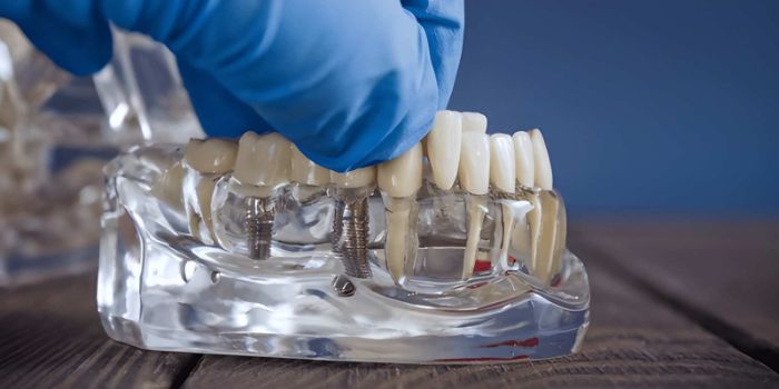Best Dental Implant in Carlisle PA Affordable Expert Care