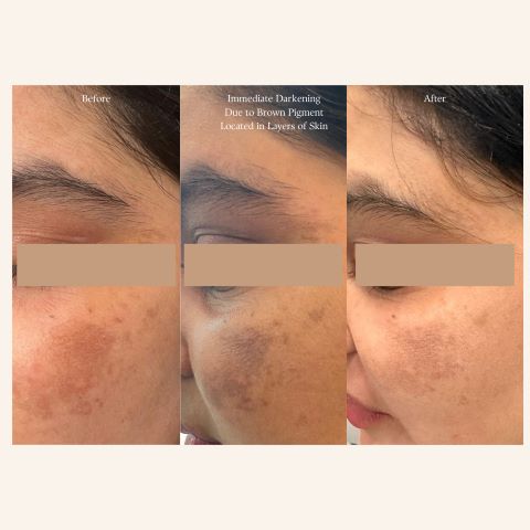 Melasma Treatment