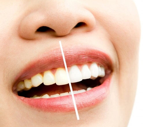 Professional Teeth Whitening PA Services Delivering Brighter Smiles With Comfortable Modern Dental Care